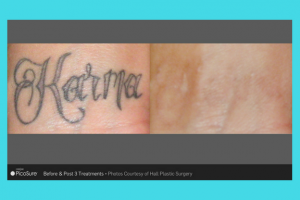 Laser Tattoo Removal in Houston, TX