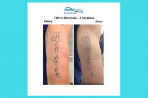 Laser Tattoo Removal in Houston, TX