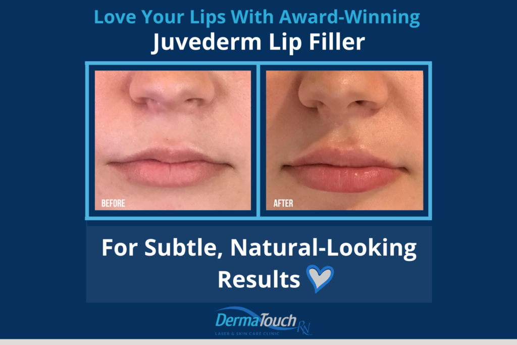 What Is The Best Lip Filler For Fuller Lips Dermatouch Rn