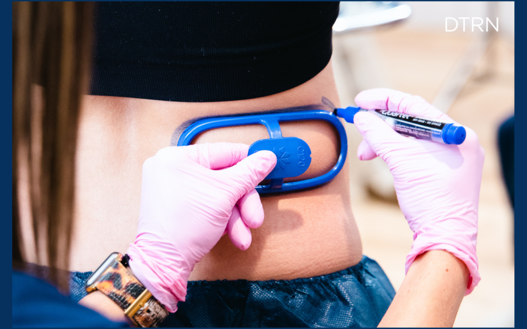 CoolSculpting vs. Liposuction: Which Should I Choose?